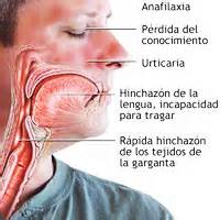 Concepto de anafilaxia