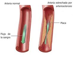 Concepto de arterioesclerosis